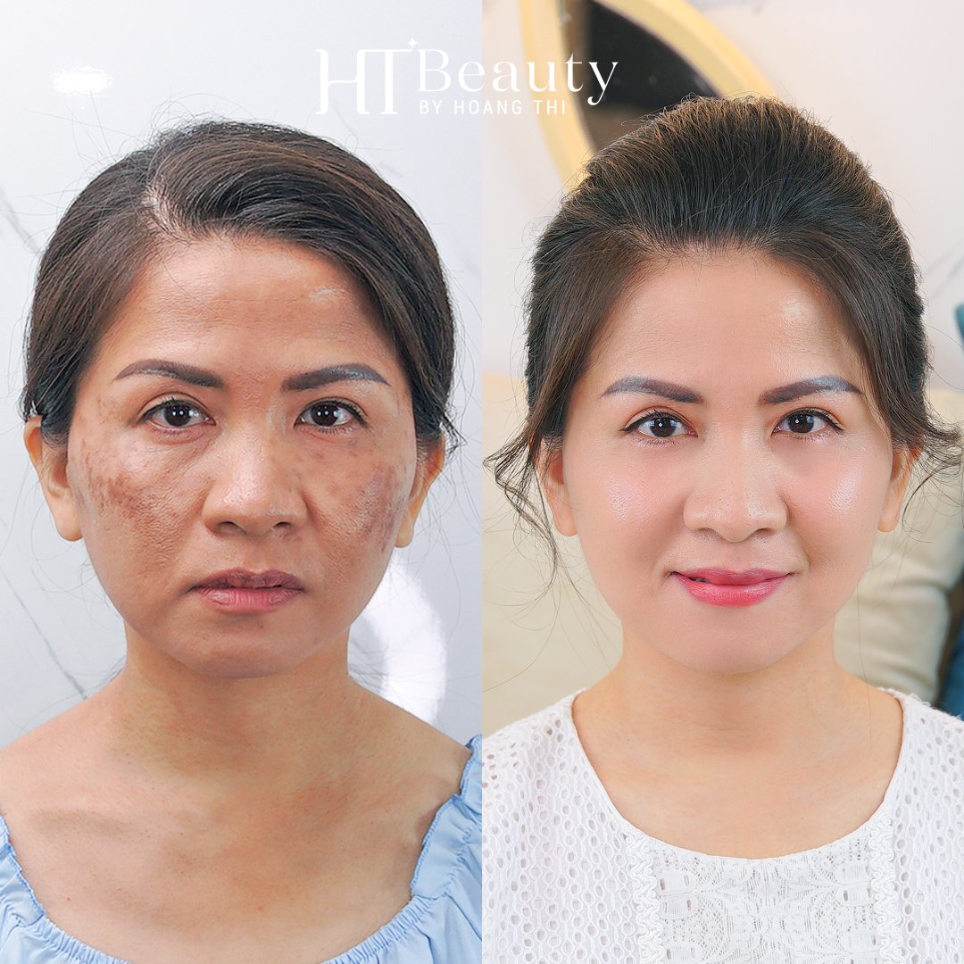 hieu qua dieu tri nam