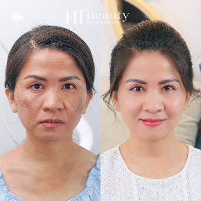 hieu qua dieu tri nam