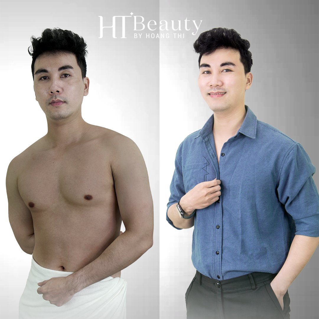 hieu qua tam trang nam