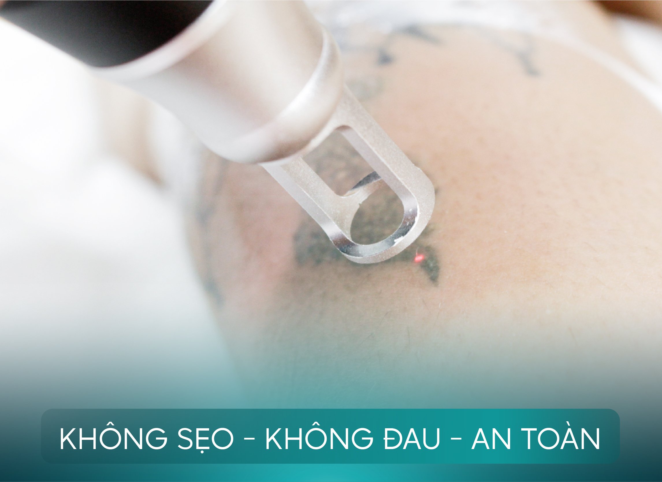 Công xoá xăm không dể lại sẹo