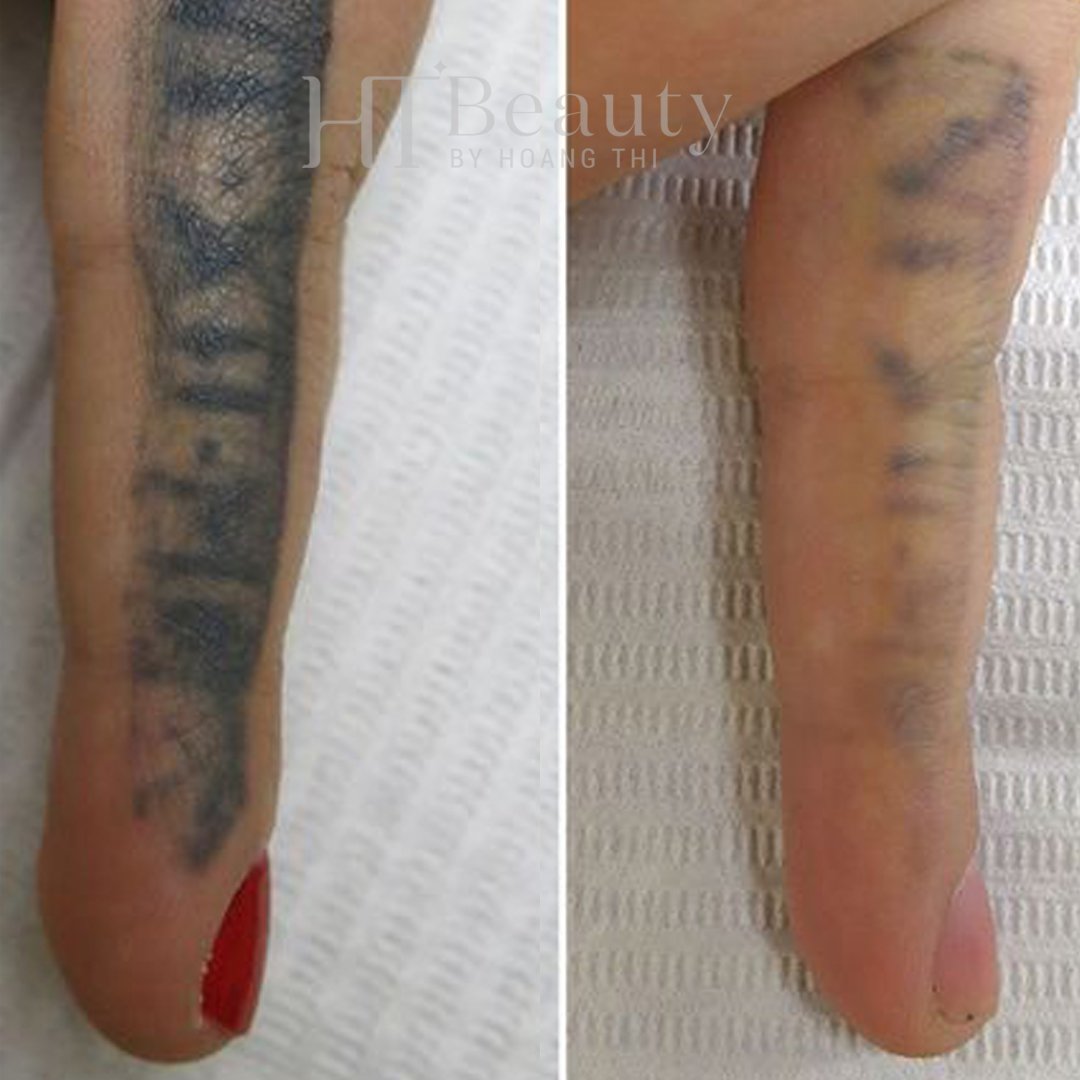 hiệu quả xoá