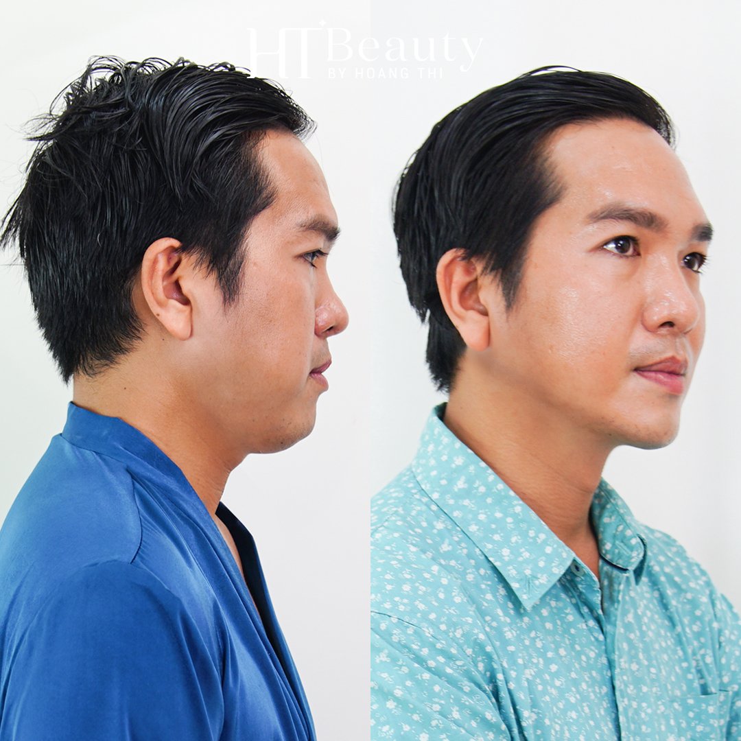 trước sau vline therapy1