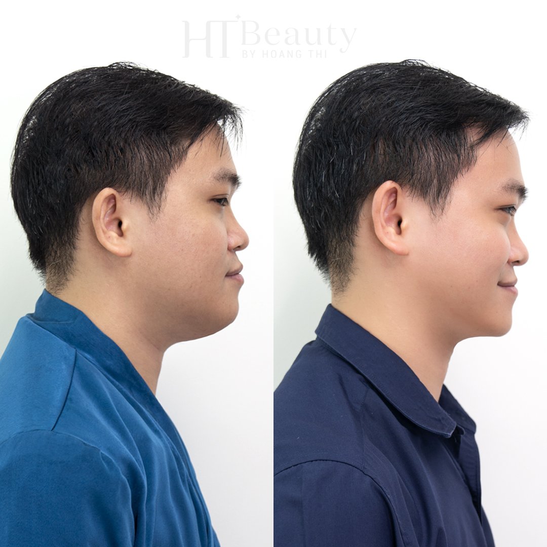trước sau vline therapy2