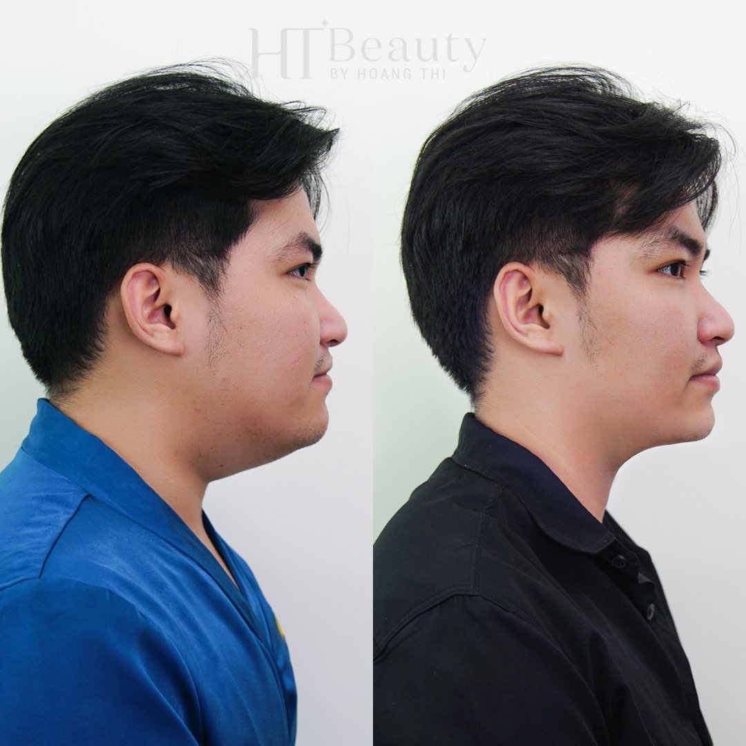 trước sau vline therapy3
