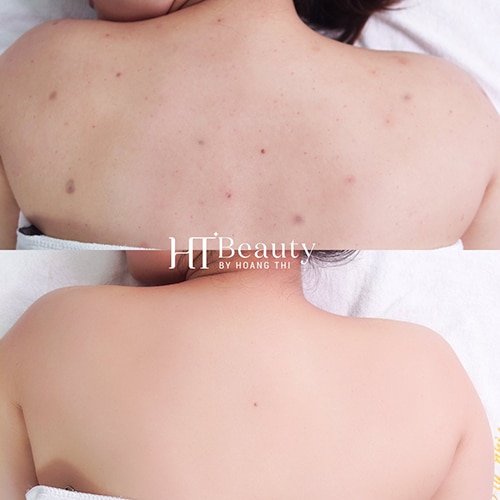 Khách hàng điều trị tại HT Beauty