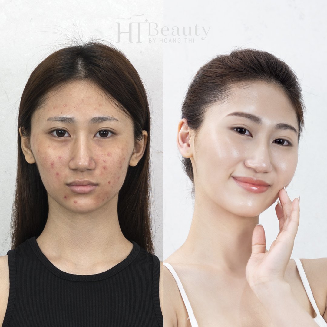 Hình trước sau trị mụn