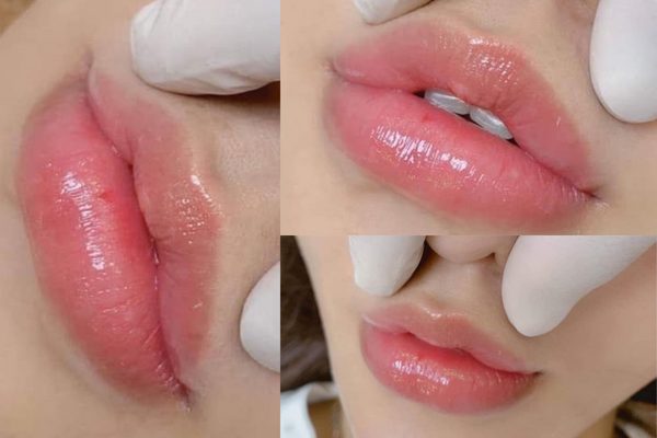 Những kiểu tiêm filler môi hot trend 2022