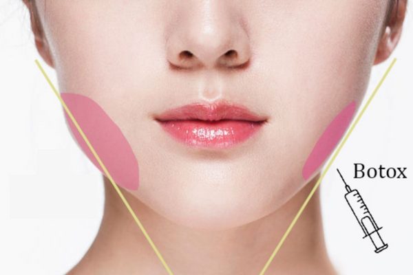 Tiêm botox gọn hàm giúp hiệu quả thon gọn cằm như thế nào