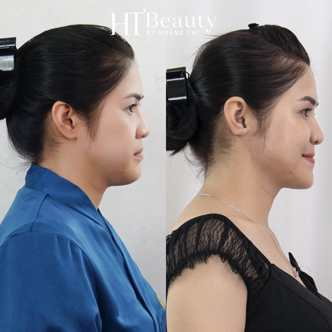 trước sau vline therapy