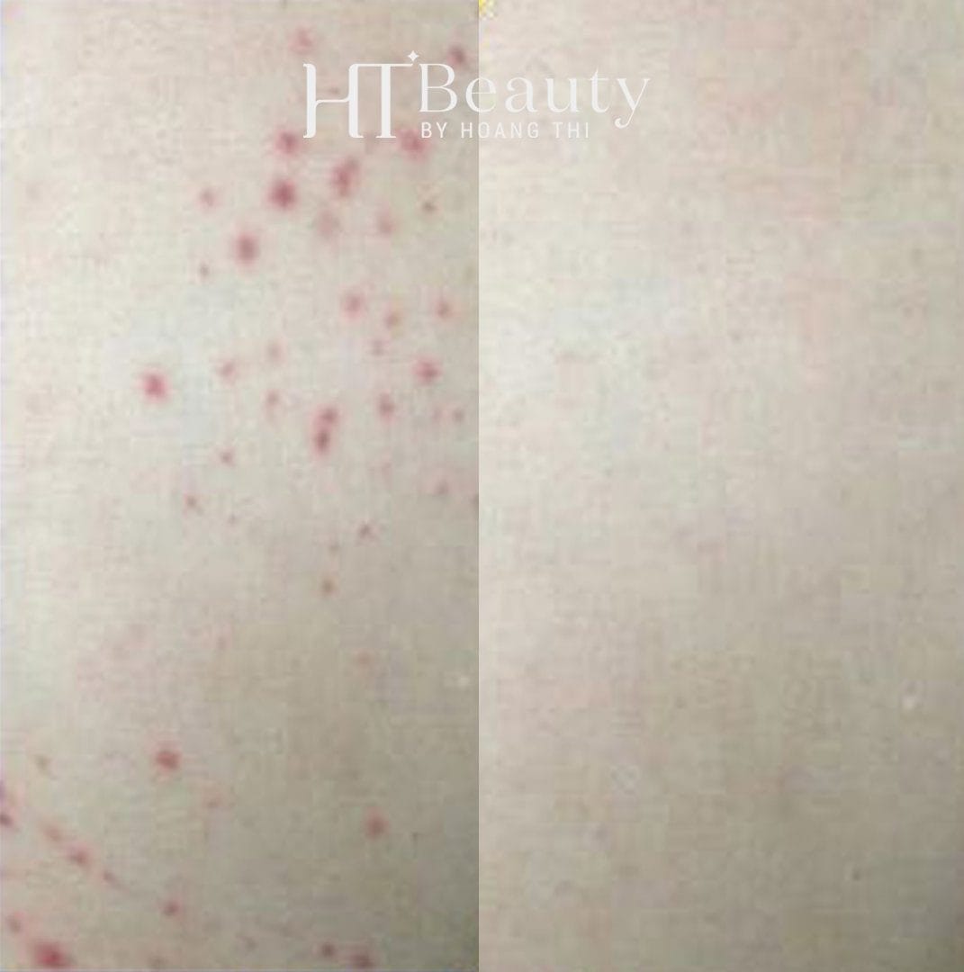 Điều trị mụn lưng