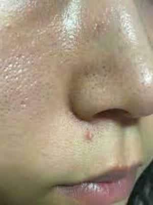 Da dầu nhờn, lỗ chân lông to