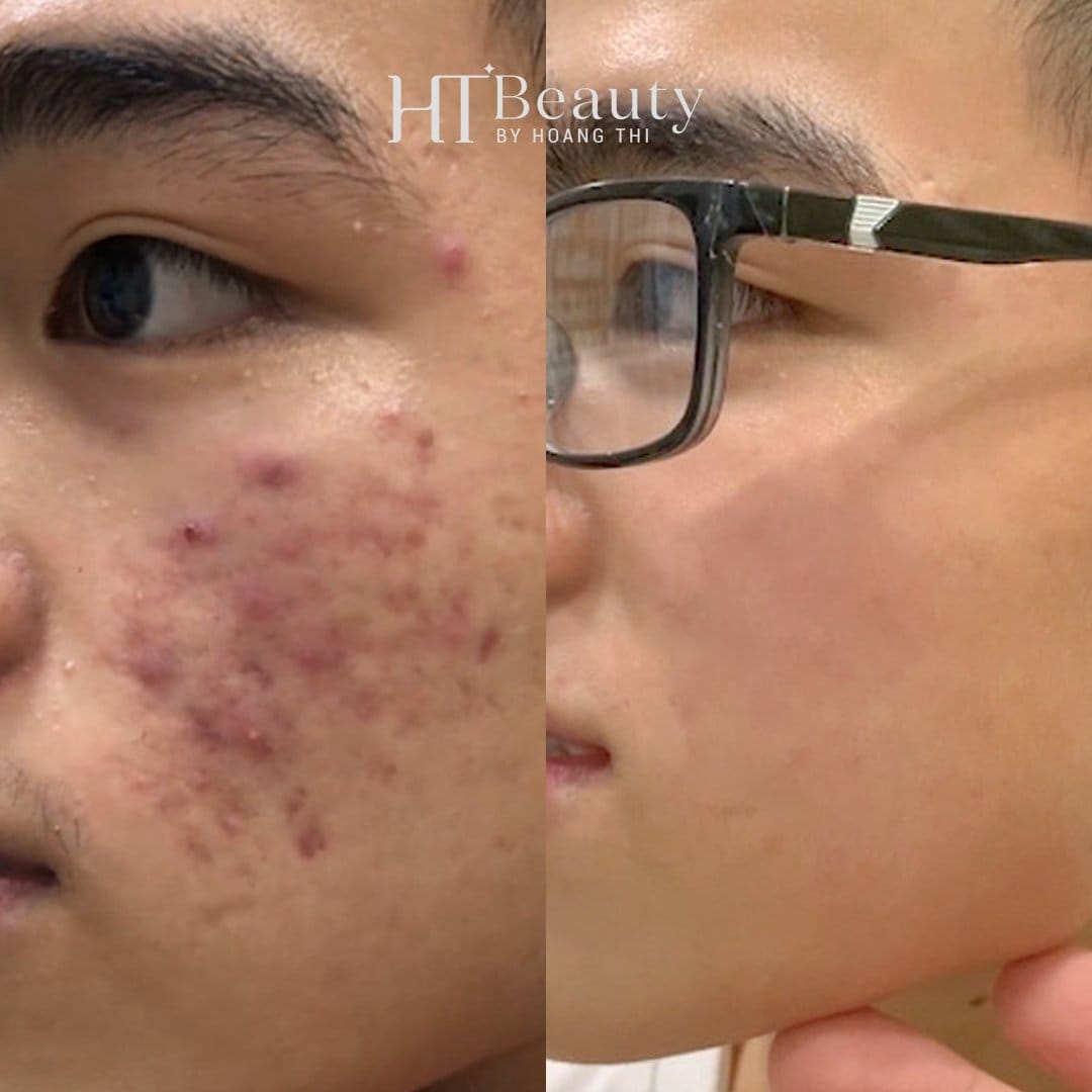 Hình trước sau trị mụn