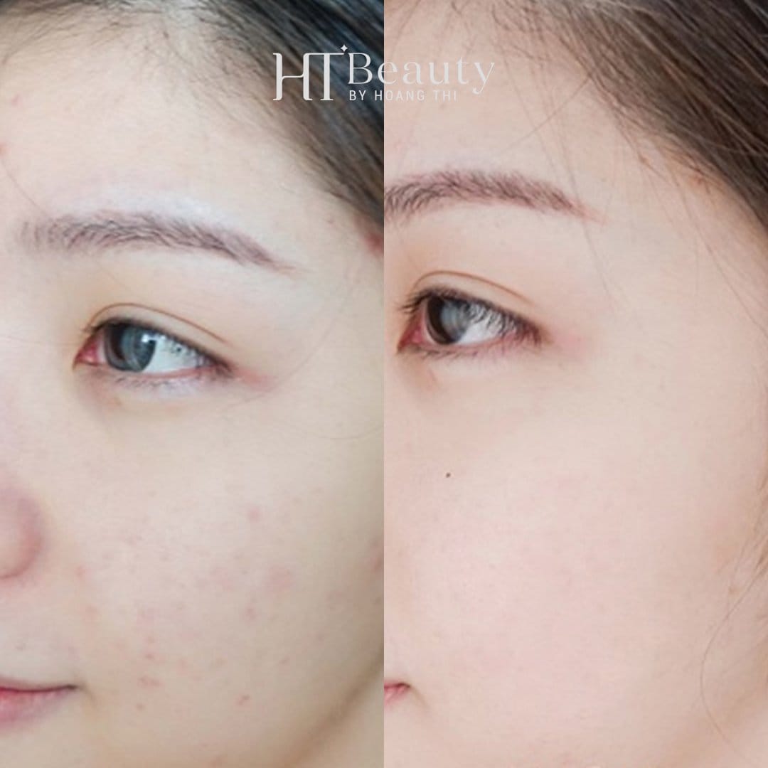 hinh truoc sau tri mun 1