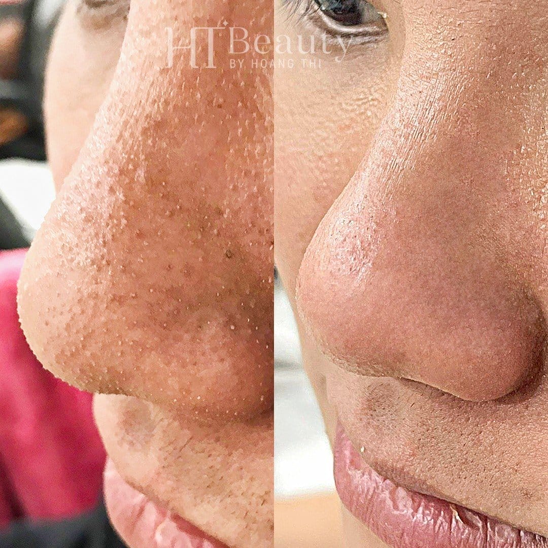 Khách hàng điều trị mụn tại HT Beauty