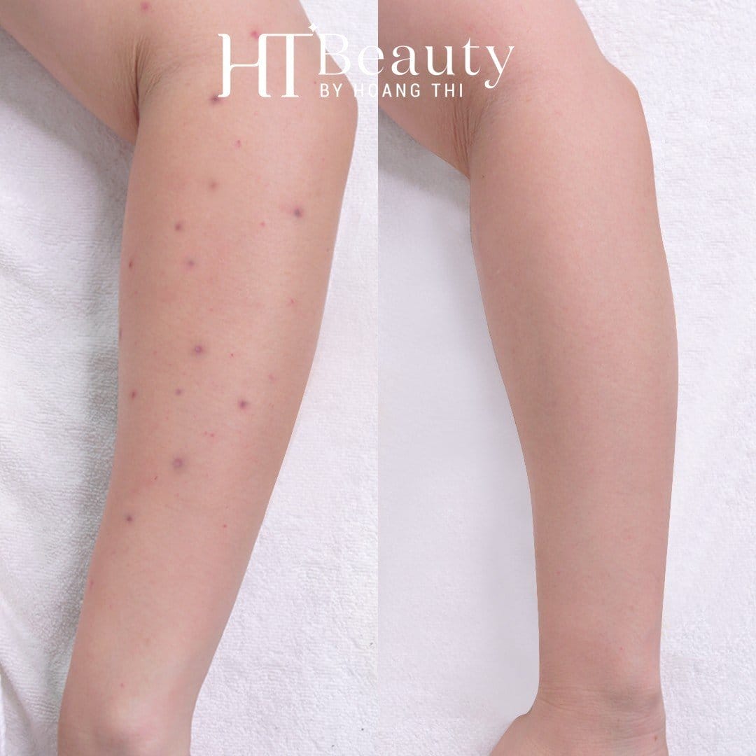 Khách hàng điều trị viêm nang lông tại HT Beauty