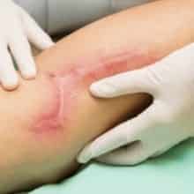 Sẹo lõm do tai nạn