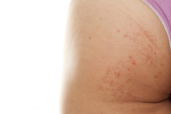 Điều trị thâm mông