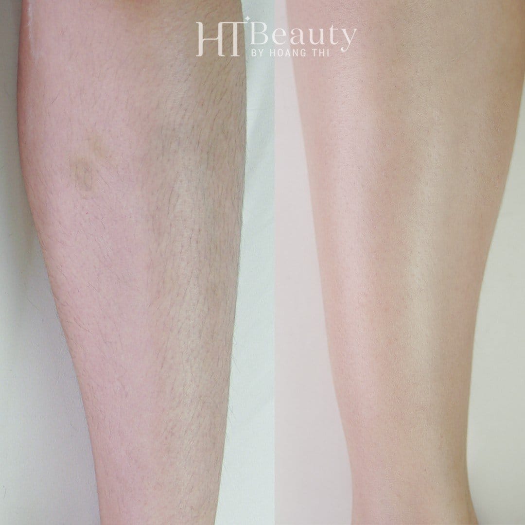 Trước sau triệt lông chân