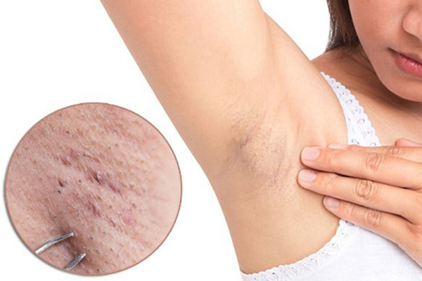 Xử lý lông sai cách khiến thâm da