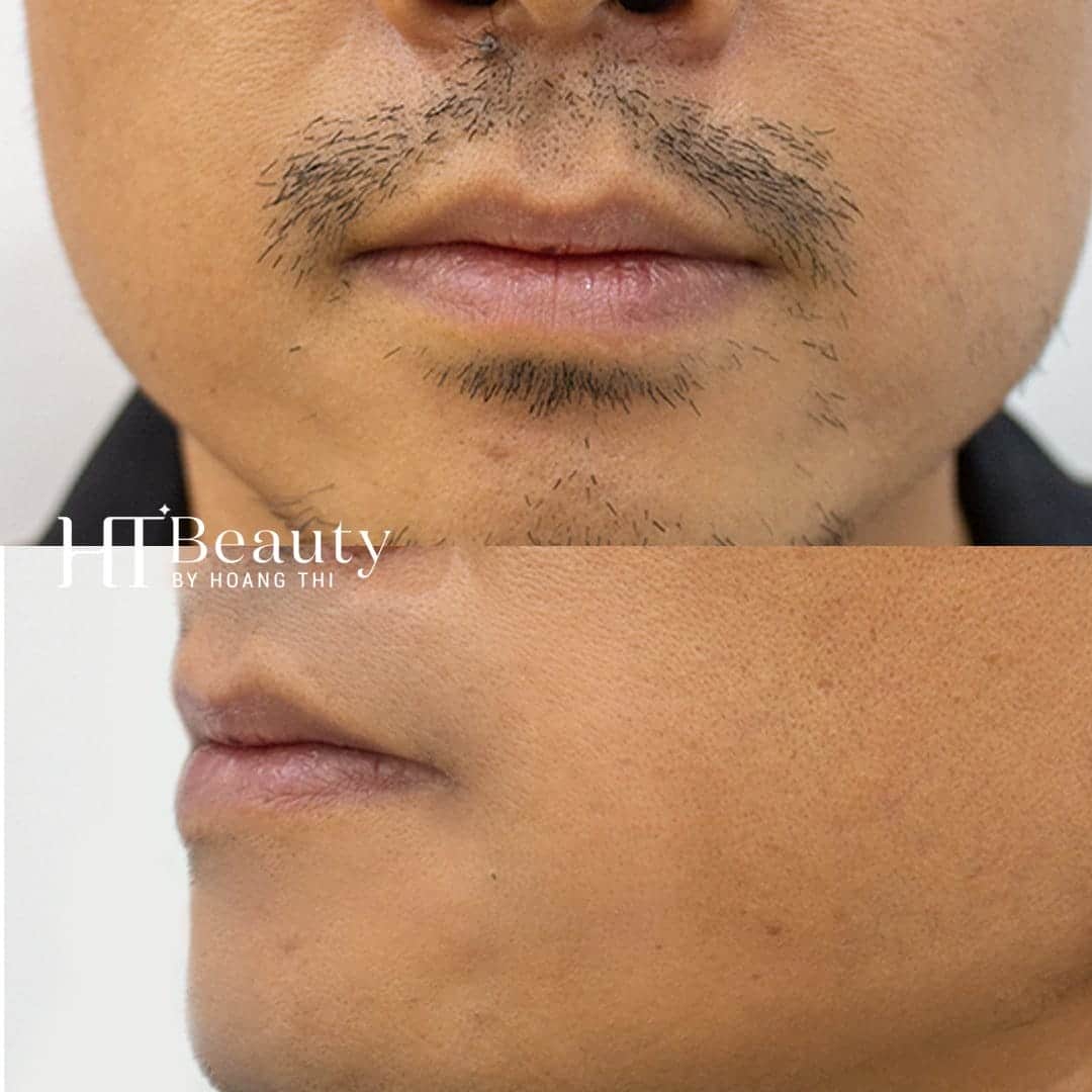 Khách hàng triệt lông