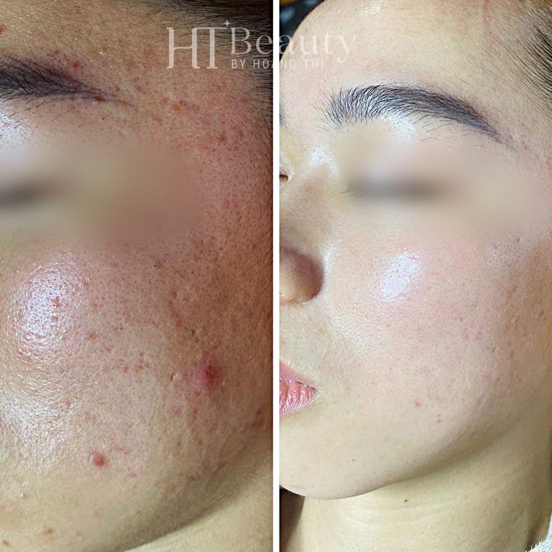 Khách hàng điều trị mụn tại HT Beauty