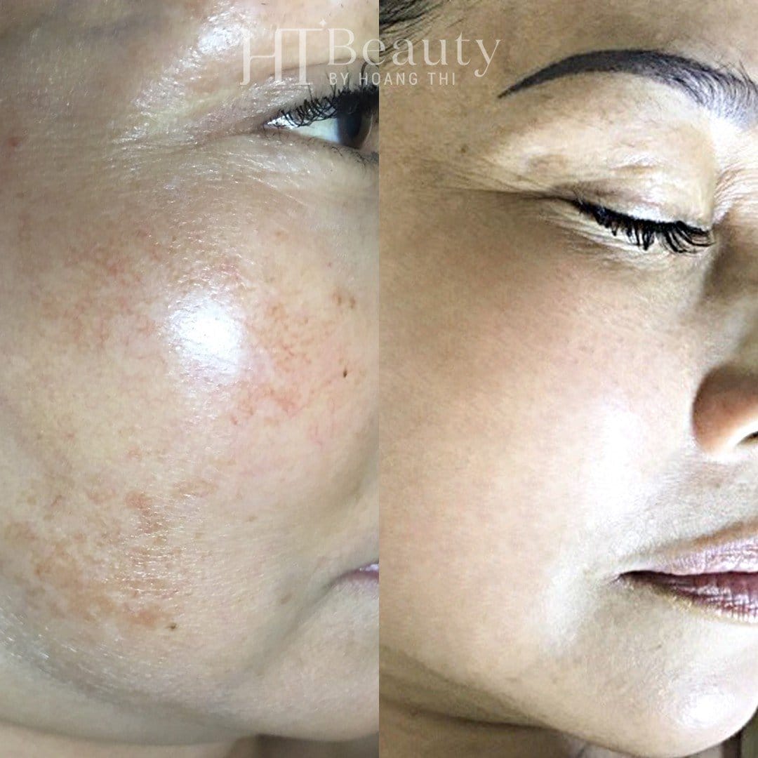 Khách hàng trị nám da tại HT Beauty