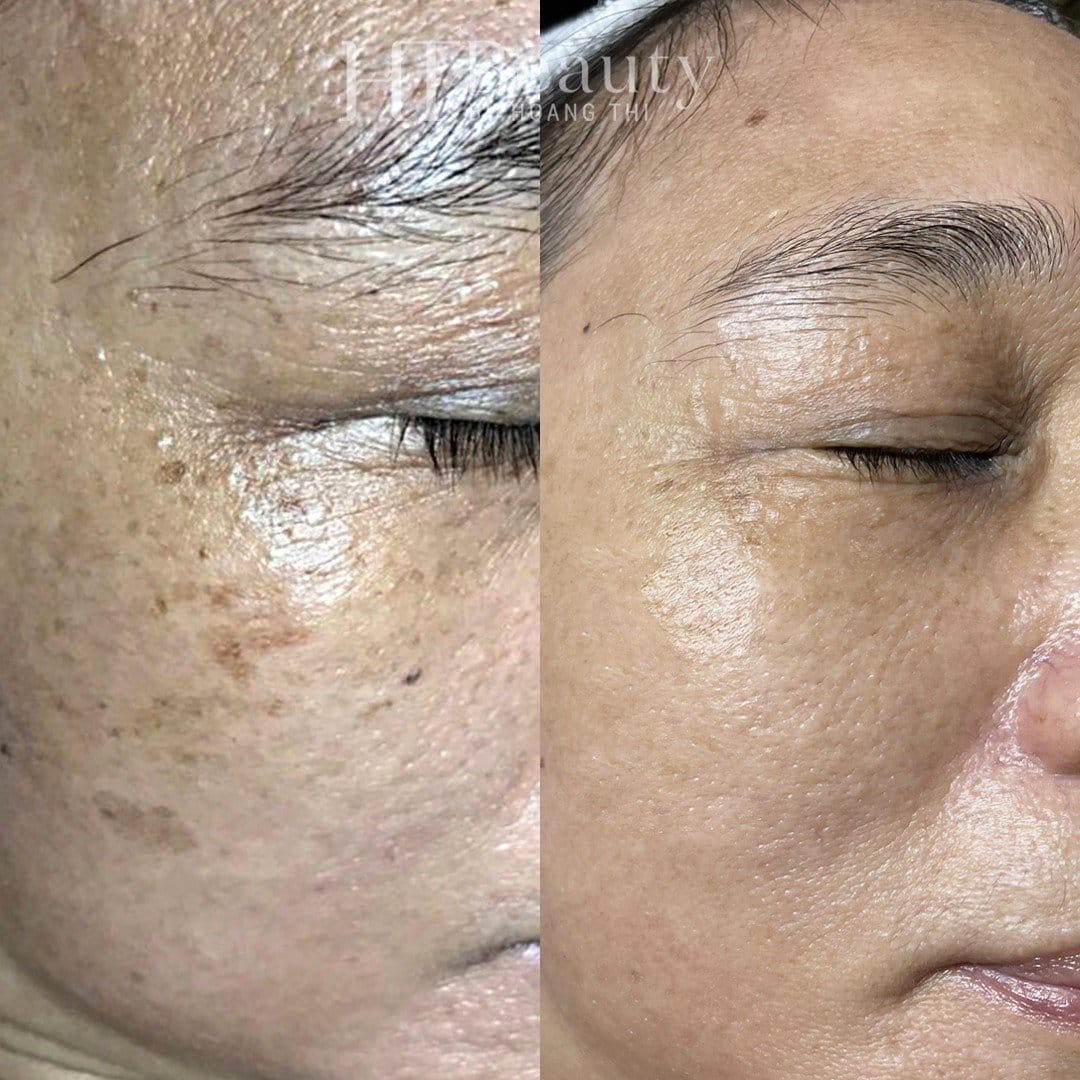 Khách hàng trị nám da tại HT Beauty
