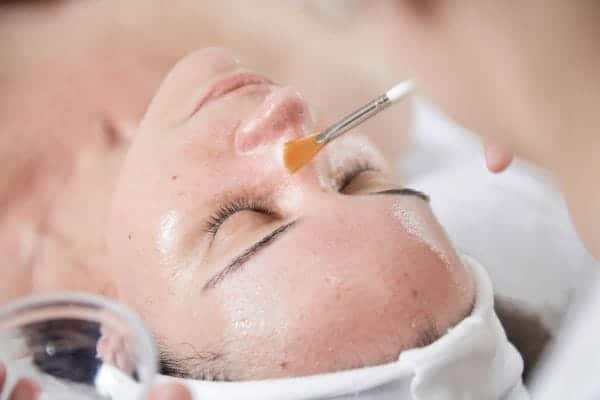 Công nghệ trị nám tốt nhất hiện nay - Peeling