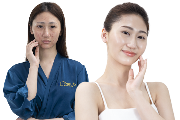 cau chuyen khach hang dieu tri mun tai ht beauty 3