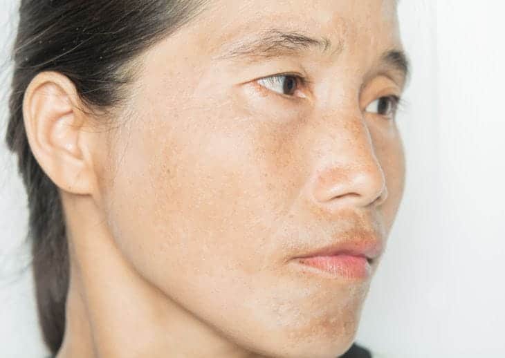 Da sần sùi, đen sạm