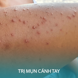 Điều trị mụn cánh tay