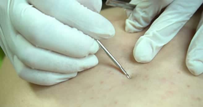 Điều trị mụn body