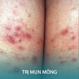 Điều trị mụn mông