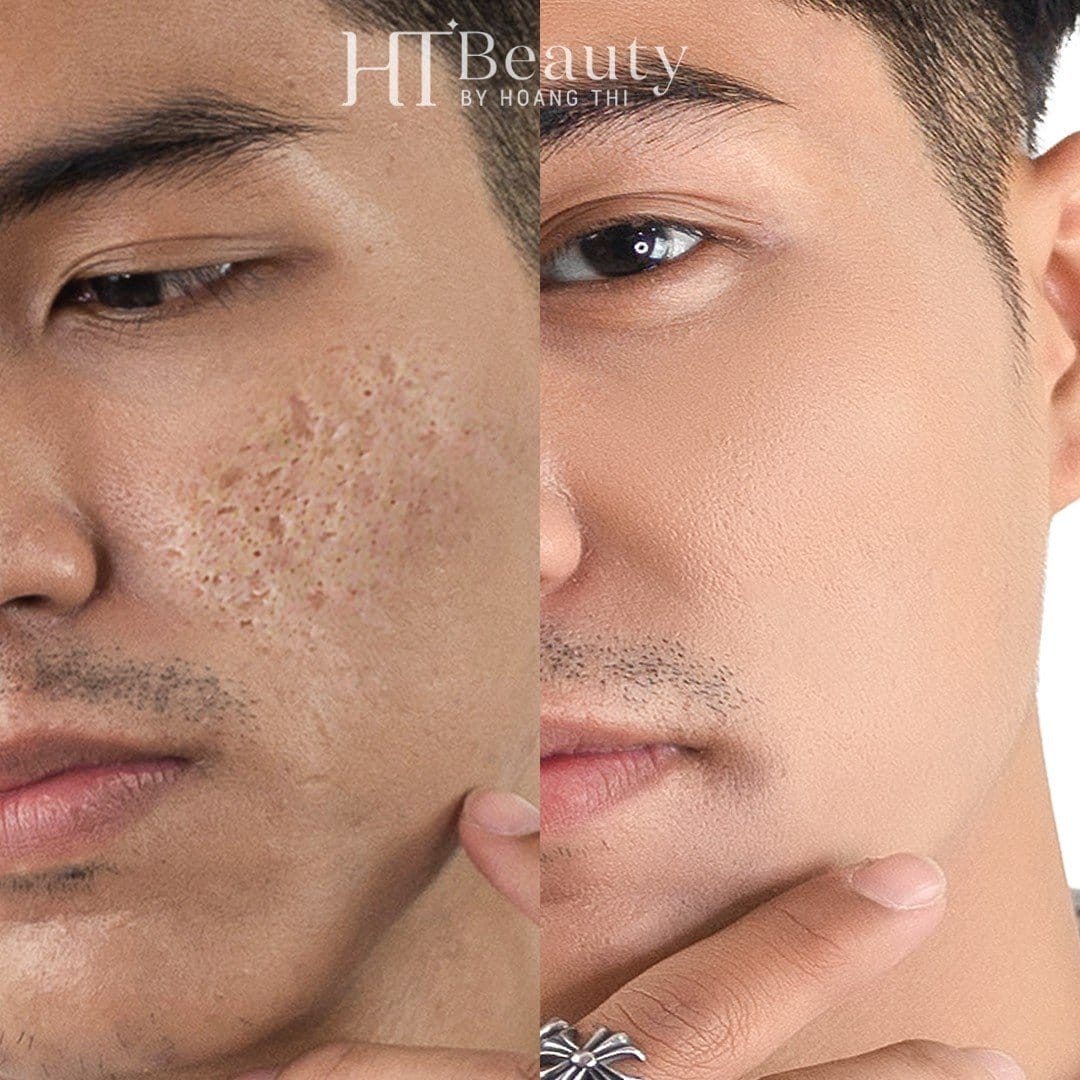 Hình trước sau điều trị sẹo rỗ