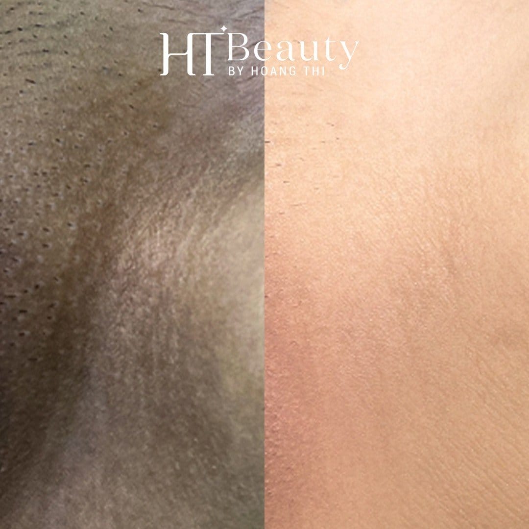 Hình ảnh sau điều trị thâm bẹn