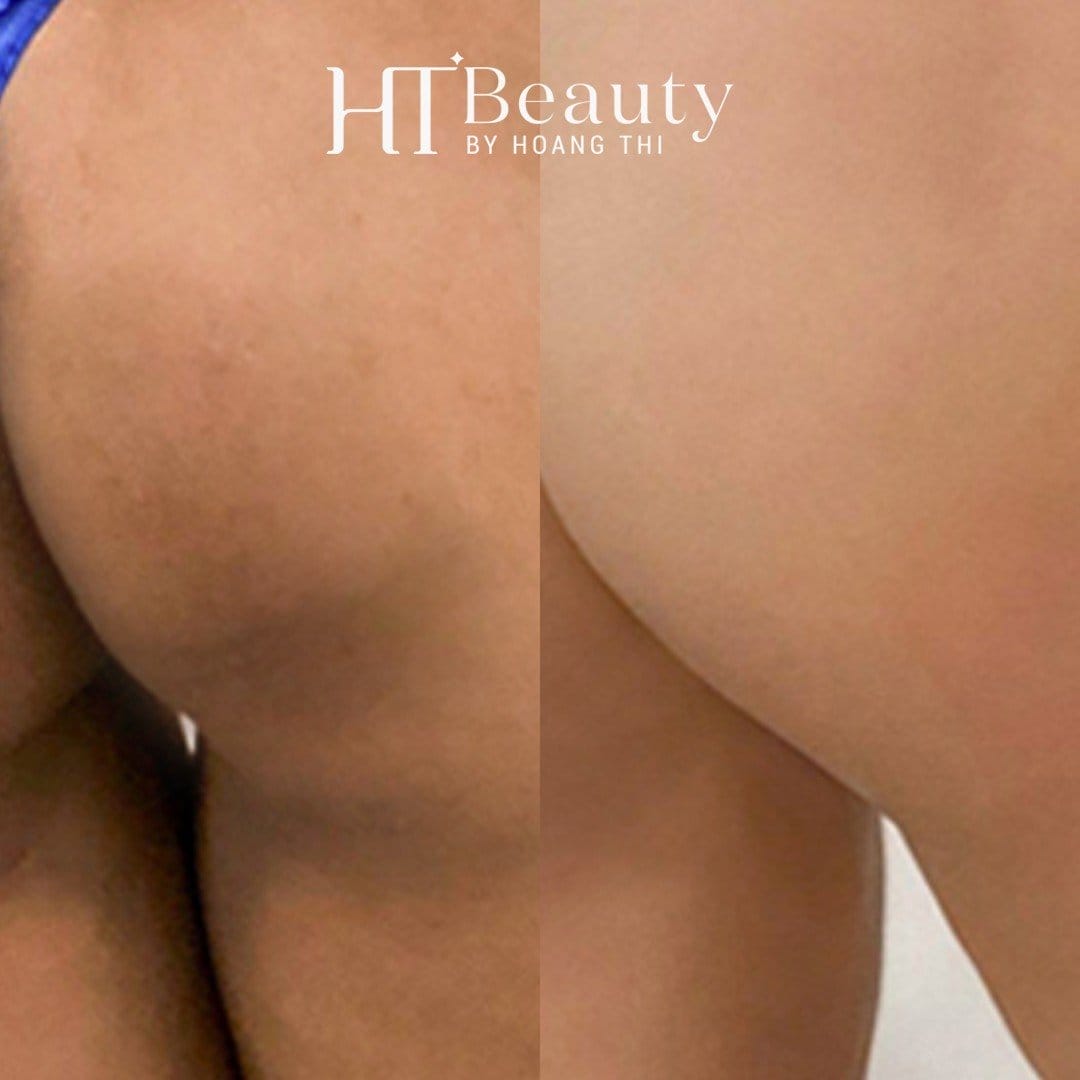 Hình ảnh sau điều trị thâm mông