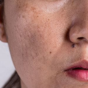 Nám da khách hàng Ngân