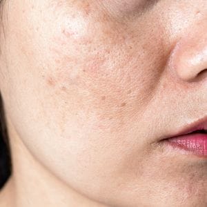 Nám da khách hàng Phương