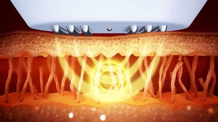 Sóng rf tác động trẻ hóa làn da