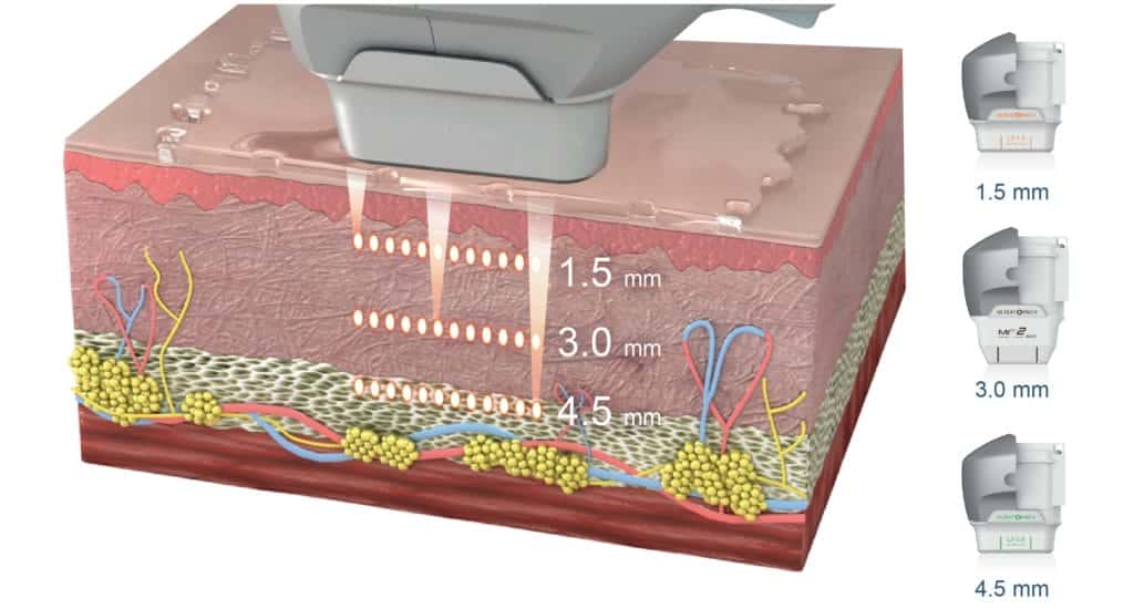 Công nghệ trẻ hóa da Vline Therapy