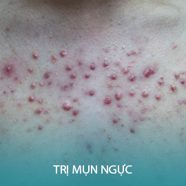 Điều trị mụn ngực