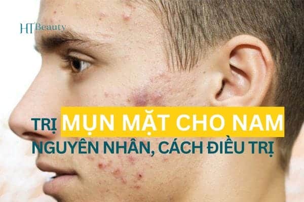 trị mụn mặt cho nam