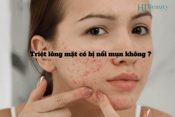 Triet long mat co bi noi mun khong