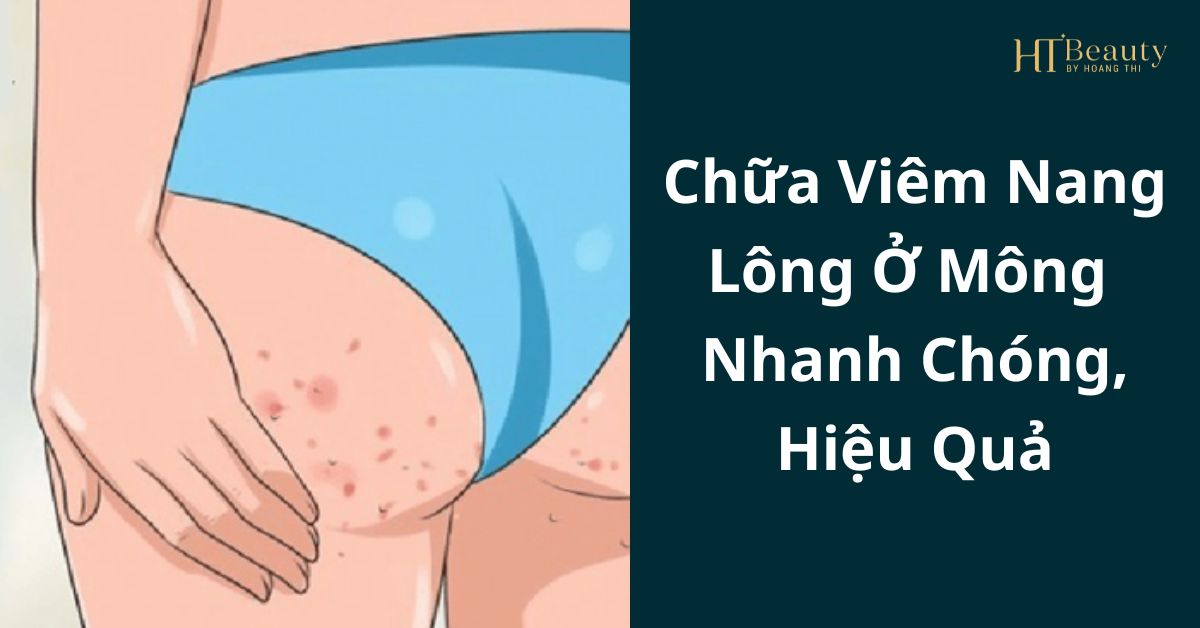 Chữa viêm nang lông ở mông nhanh chóng, hiệu quả