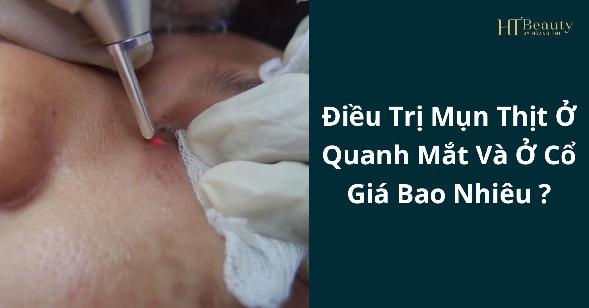 Điều Trị Mụn Thịt Ở Quanh Mắt Và Ở Cổ Giá Bao Nhiêu?