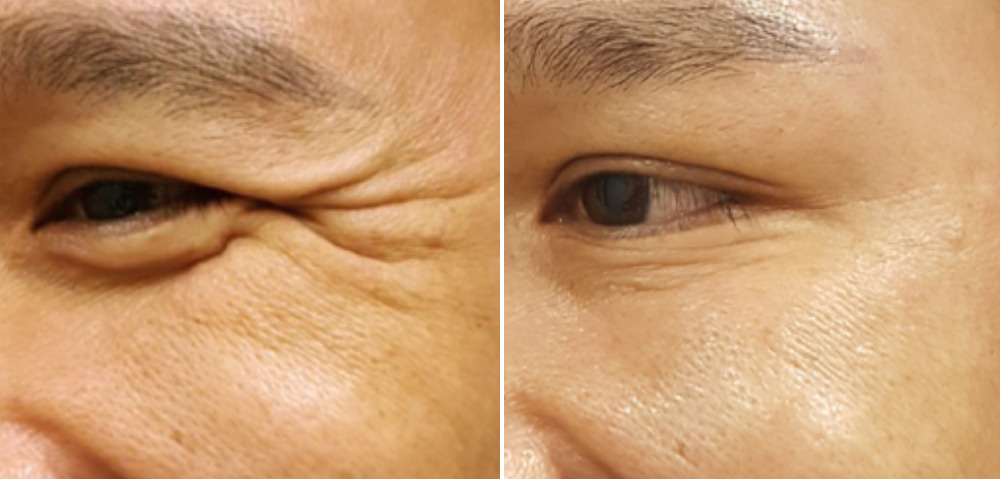 hieu qua truoc sau xoa nhan mat ht beauty