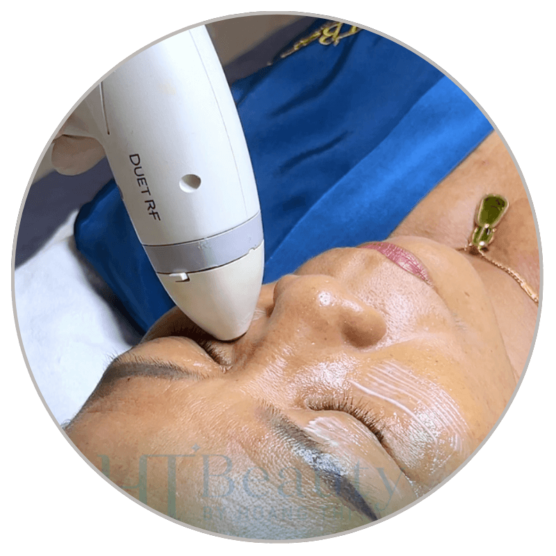 quy trinh xoa nhan mat