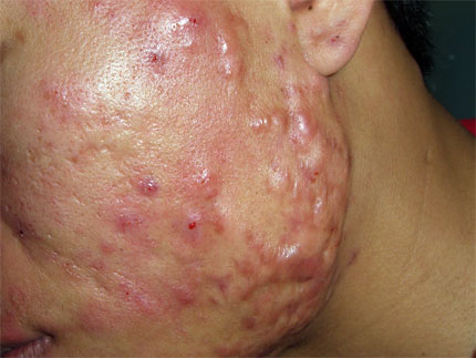 mun boc la gi va giai phap xu ly mun the nao cho hieu qua 2