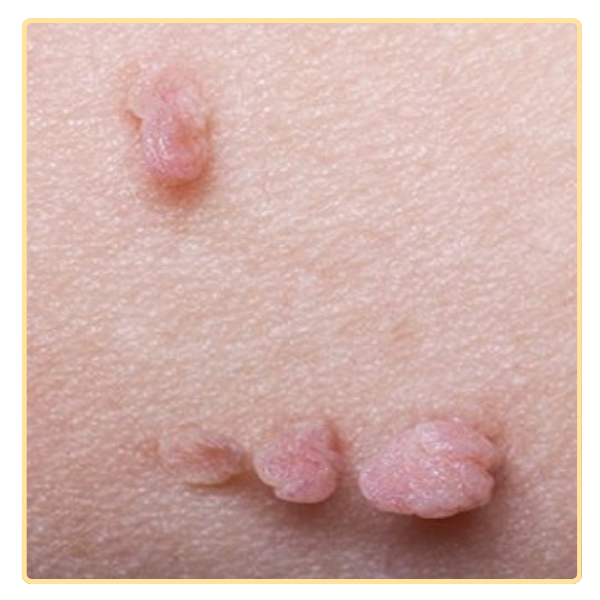 cap do mun thit nang