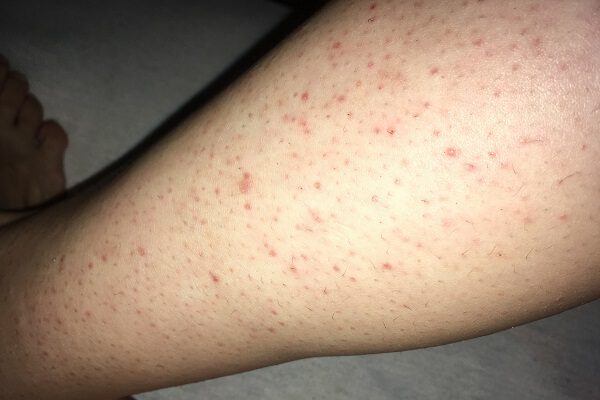 cach chua viem lo chan long o chan 2